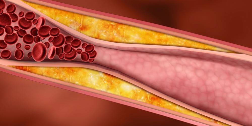 Colesterolo e rischio cardiovascolare